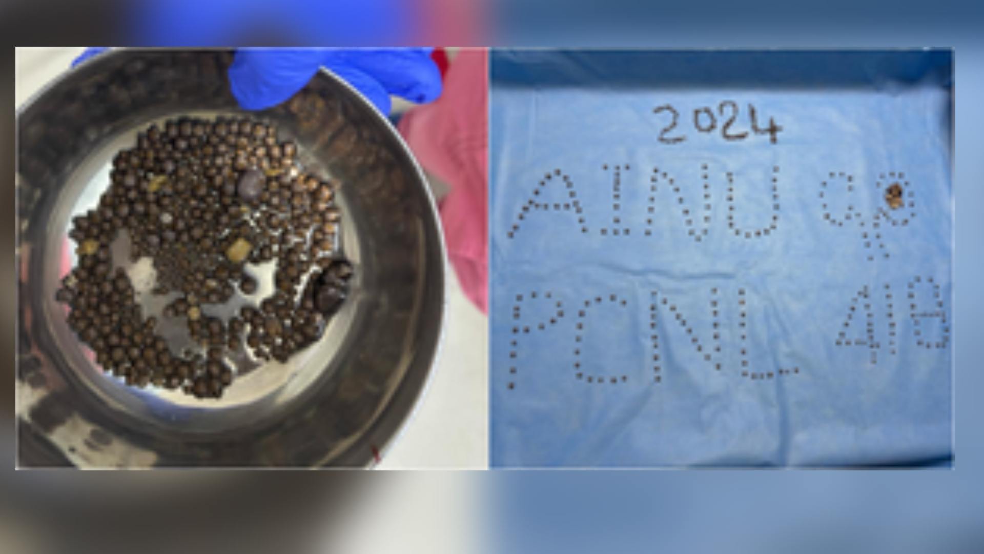 418 Kidney Stones Removed From Patient At Hyderabad’s AINU