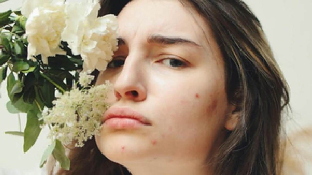 Acne spots, a stubborn reminder that you need glutathione