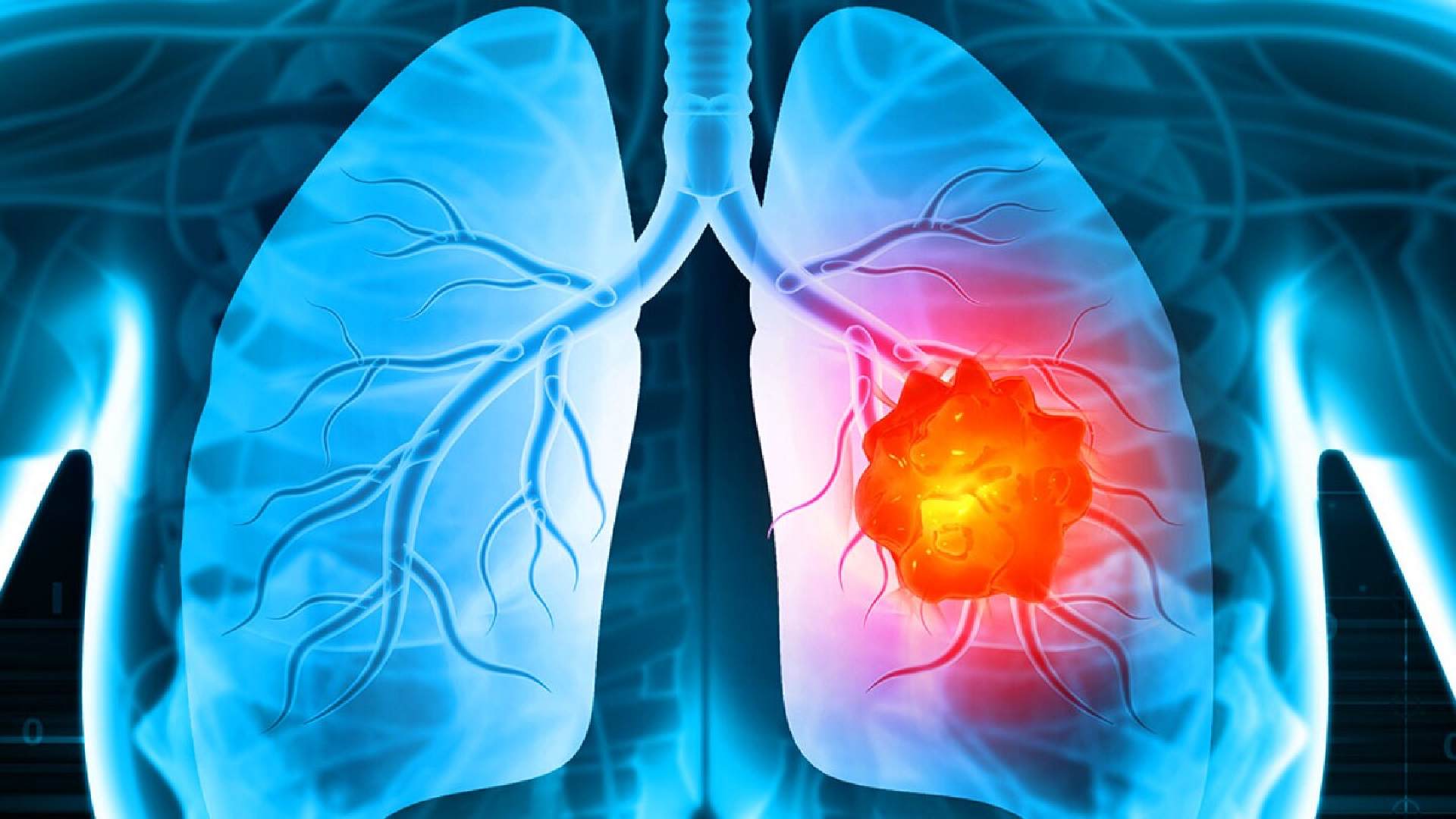 Are Most Lung Cancer Patients Smokers