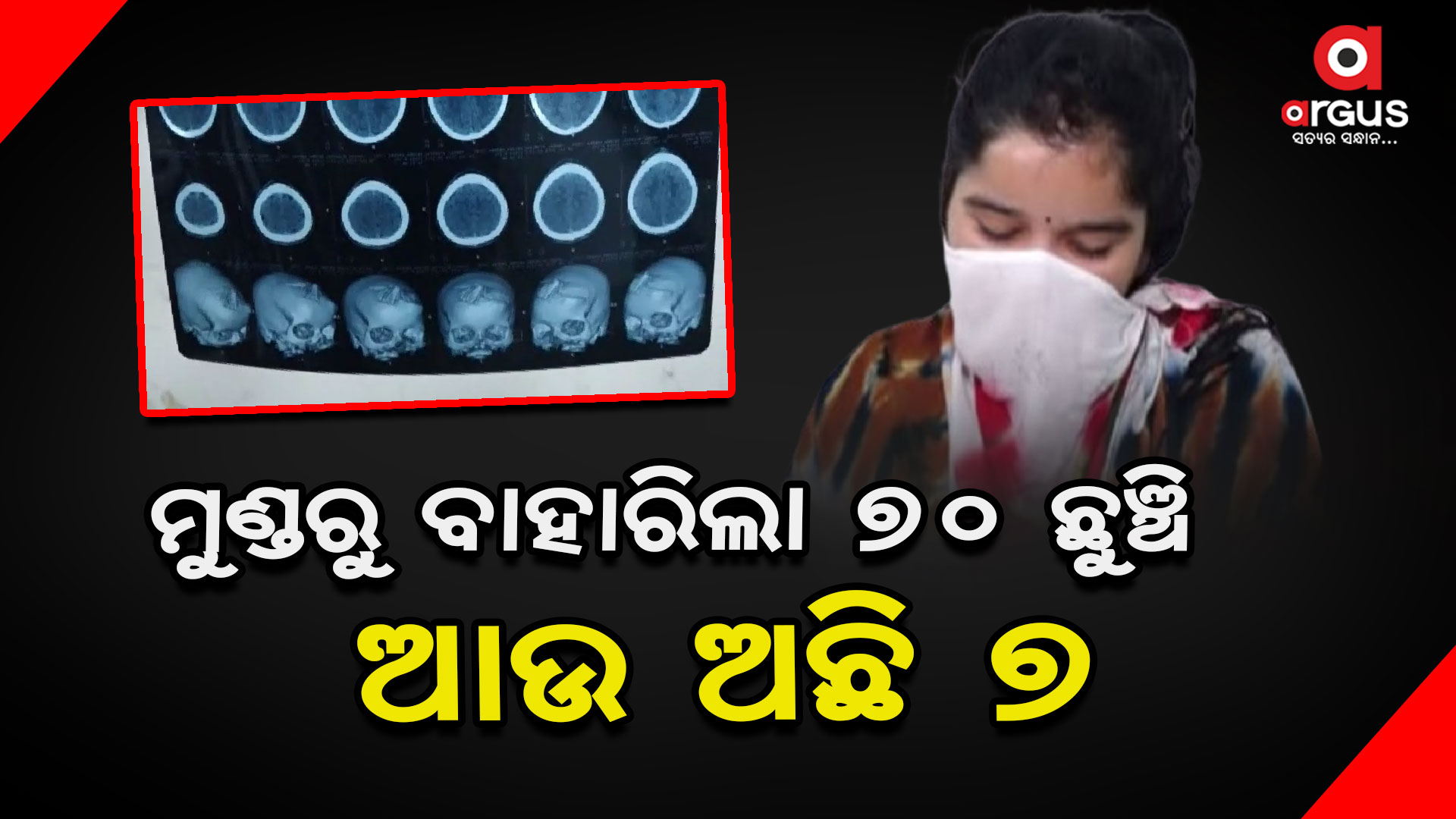 ଯୁବତୀଙ୍କ ମୁଣ୍ଡରୁ ବାହାରିଲା ୭୦ ଛୁଞ୍ଚି, ଆଜି ବାହାରିବ ଆଉ ୭